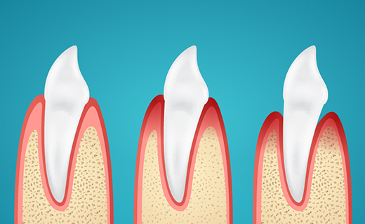 dca-blog_causes-of-gingivitis-and-gum-disease